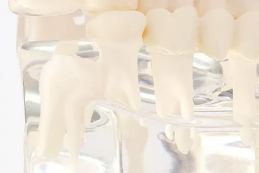 親知らずの抜歯について