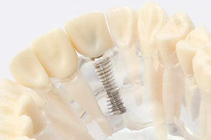 インプラント