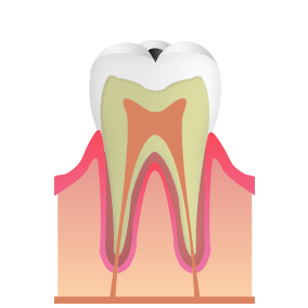 C1：歯の表面（エナメル質）の虫歯