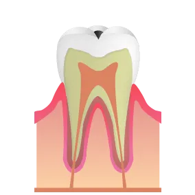 C1：歯の表面（エナメル質）の虫歯