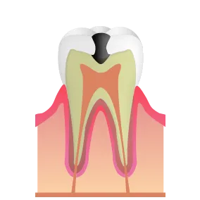 C2：象牙質の虫歯