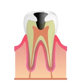 C3：神経まで進行した虫歯