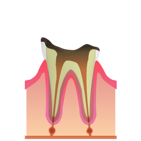 C4：歯の根まで進行した虫歯