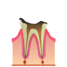 C4：歯の根まで進行した虫歯